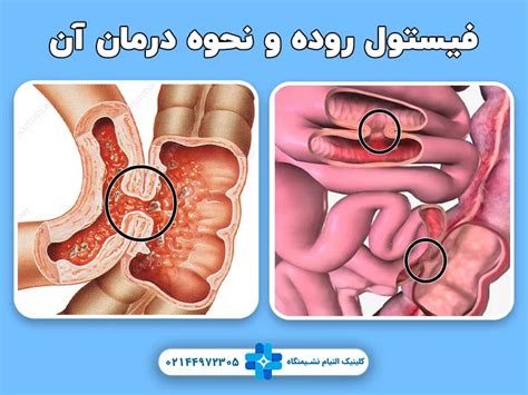 فیستول روده چیست علائم درمان و تفاوت آن با فیستول مقعد کلینیک