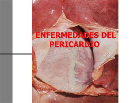 Enfermedades Del Pericardio Oscar OM UDocz