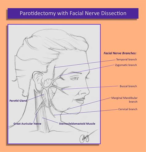 Parotid Surgery: Parotidectomy and Facial Nerve Dissection