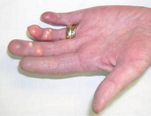 Calcinosis Cutis In Systemic Sclerosis Springerlink