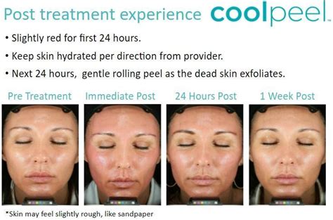 Coolpeel Downtown Dc Washington Dc Metroderm Dc Medical Laser And Aesthetic Dermatology