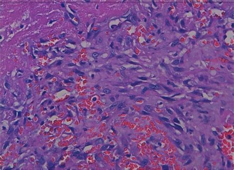 Primary Angiosarcoma Of The Breast A Case Report Diagnostic