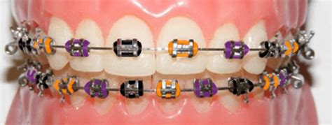 cute braces colors for halloween - Rueben Downey