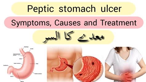 Peptic Ulcer Disease Causes Symptoms Diagnosis Treatment Gastric