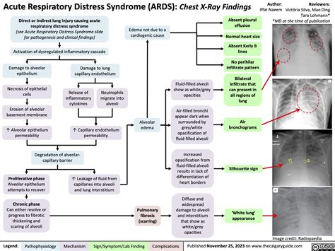 Acute Respiratory Distress Syndrome Ards Cxr Findings Calgary Guide