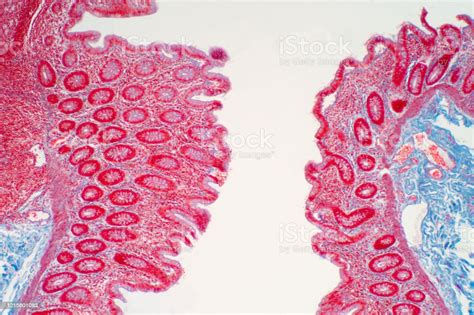 Colon Biopsy From The Colonoscopy The Pathology Report Describes Normal