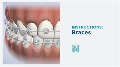 Braces Instructions In Fresno Ca Nalchajian Orthodontics Youtube