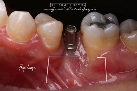 free gingival graft around implant (stage 1 )