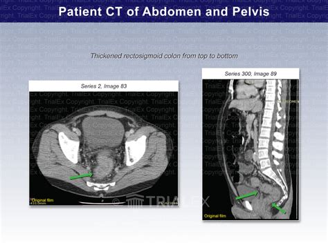 Patient Ct Of Abdomen And Pelvis Trial Exhibits Inc