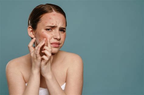 Proven Care Tips For Acne Prone Skin