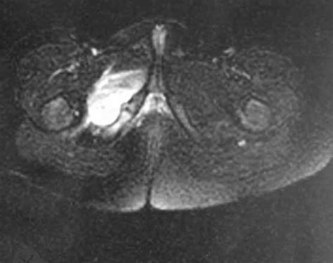 Mri Performed Three Days After The Onset Of Symptoms A Coronal Stir