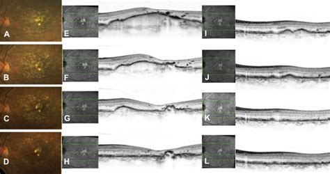 Aed Color Fundus Images Of A Patient With A Drusenoid Pigment