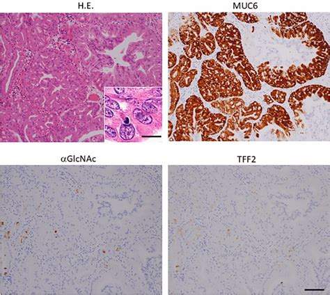 Immunohistochemical detection of MUC6 αGlcNAc and TFF2 positive