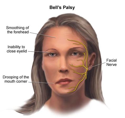 Bells Palsy Anesthesia Considerations At Kimberly Salmon Blog