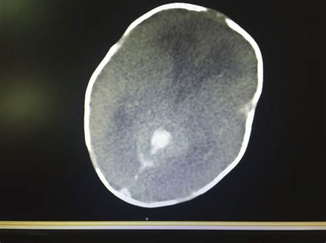 Brain Stem Bleed Seen In Computed Tomography Brain Figure 2 Suddural