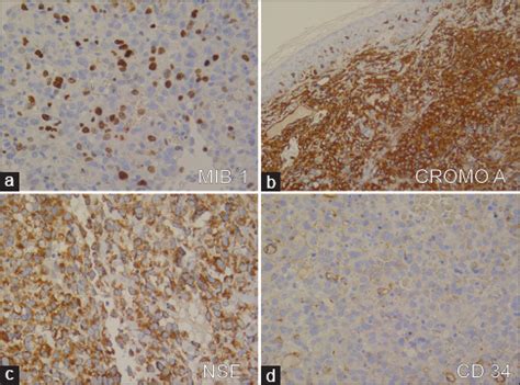 Metastatic Merkel cell carcinoma of the face - Indian Journal of Dermatology, Venereology and ...