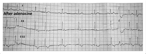 Rhythm Strip Immediately After Adenosine Bolus Interruption Of The