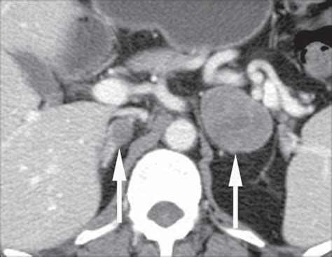 Scielo Brasil Imaging Of The Adrenal Gland Lesions Imaging Of The Adrenal Gland Lesions