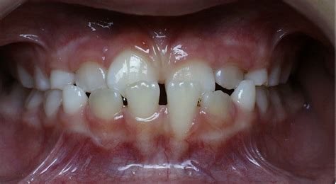 Reverse Pull Headgear Orthodontist For An Underbite