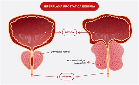 Hiperplasia prostática benigna Você já ouviu falar dessa condição