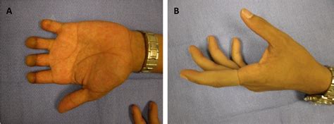 Current Indications For Abdominal Based Flaps In Hand And Forearm Reconstruction Injury