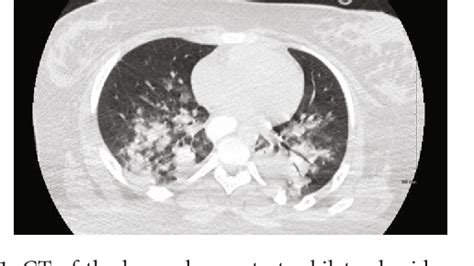 Figure 1 From Combined Hyperglycemic Hyperosmolar Syndrome And Diabetic