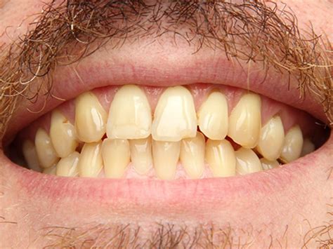 Yellow Teeth Causes And Treatment