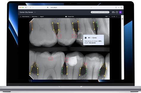 Ai Helps Dentists Catch More Cavities Gum Disease St Economic