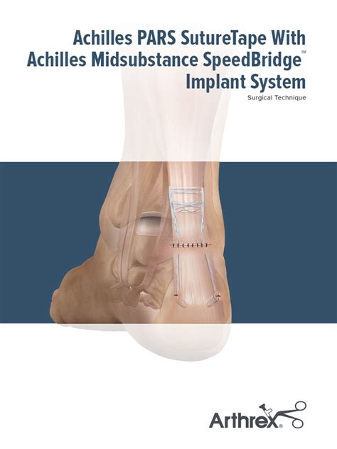 Achilles Pars Suturetape With Achilles Midsubstance Speedbridge Implant