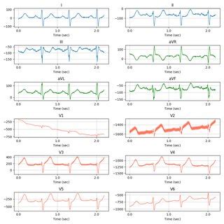 Pulse of STEMI ECG with 12-lead. Each channel has the same form as ...