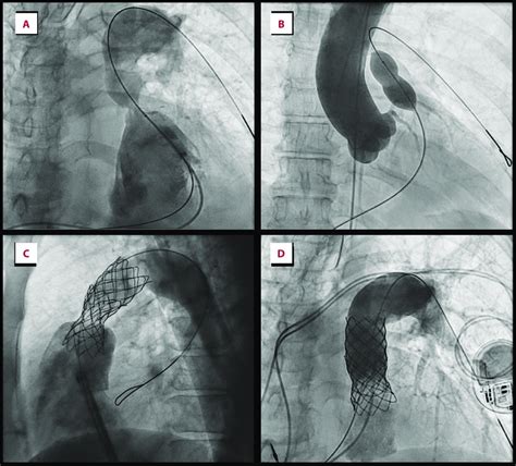 Percutaneous Pulmonary Valve Implantation Ppvi A Valvular Rvot