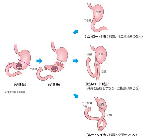 胃がんの治療｜胃がん 西新宿の地で がんに挑む 東京医科大学病院