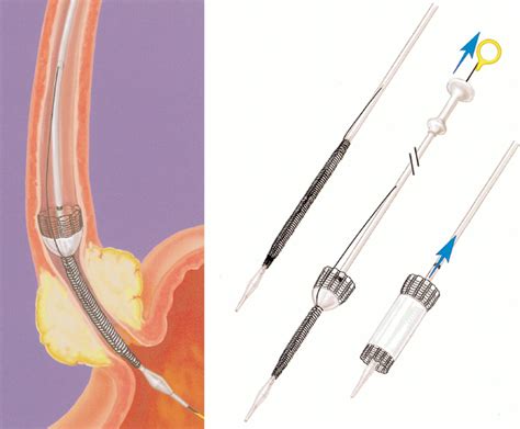 Balloon Dilation And Stent Placement For Esophageal Lesions