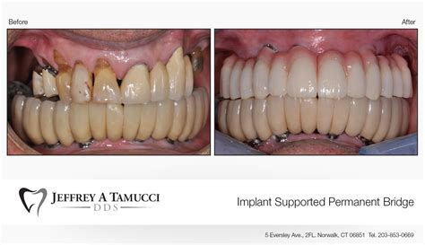 Before And Afters Jeffrey A Tamucci Dds Dental Office Ct