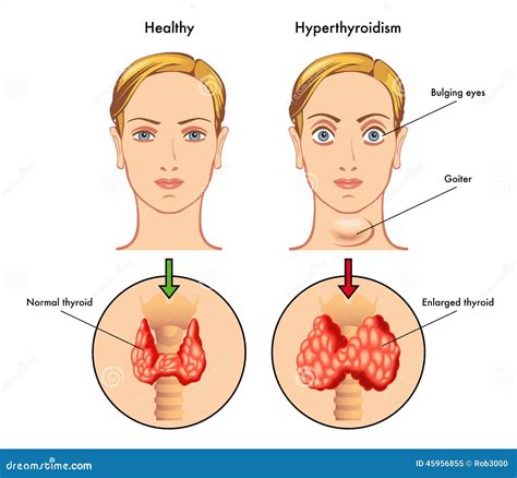 Hyperthyroidism Stock Vector Illustration Of Agitation 45956855