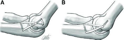 Common Techniques For Ulnar Collateral Ligament Ucl Reconstruction