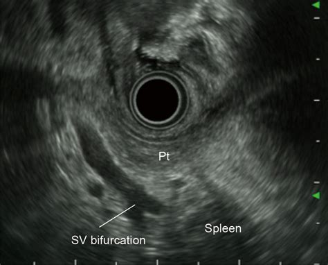 Standard Imaging Methods In The Pancreatobiliary Region Using Radial