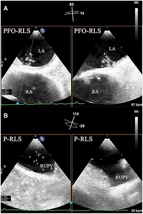 Frontiers Neglected Intrapulmonary Arteriovenous Anastomoses A