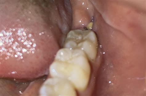 Bone Showing After Bottom Wisdom Tooth Removal Raskdentists