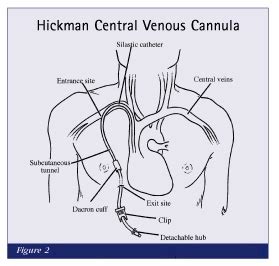 Ovarian Cancer and Me: More Chemotherapy and a Hickman Line