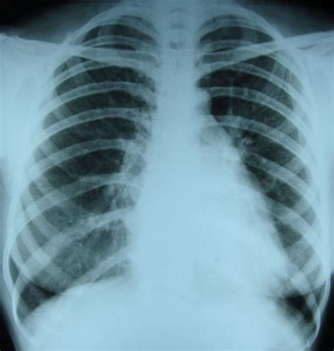 Straightening of left border in mitral stenosis – All About ...