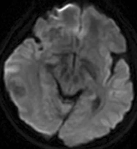 Two Lesions Were Hyperintense Signal On A Axial Mr Dwi Image