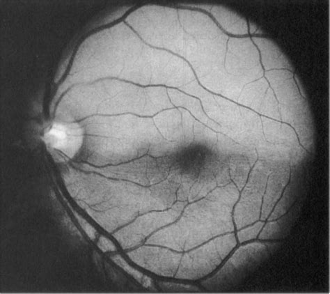 The Left Posterior Pole Note The Opaque Superior Retina And The