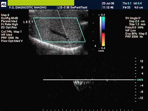 Cochinblogs Intratesticular Varicocele