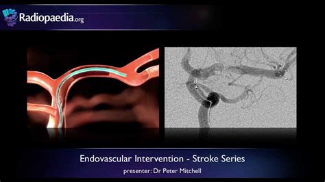 Stroke Endovascular Management Of Ischaemic Stroke Radiology Video