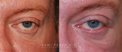 Beverly Hills Revision Eyelid Surgery Before And After Photos Los Angeles