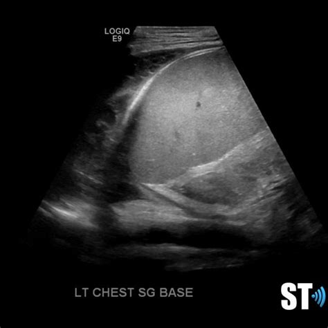 Chest And Lung Ultrasound Sonographic Tendencies Diagnostic Medical