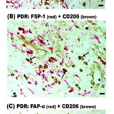 Identification Of CD68 CD206 Double Positive Cells In Epiretinal