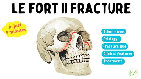 Le Fort II Fracture Made Easy In 5 Minutes Medinare YouTube