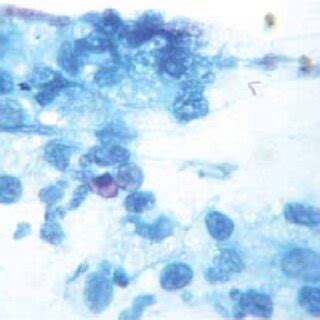 Acid fast bacilli in the upper right corner. Note the presence of an ...